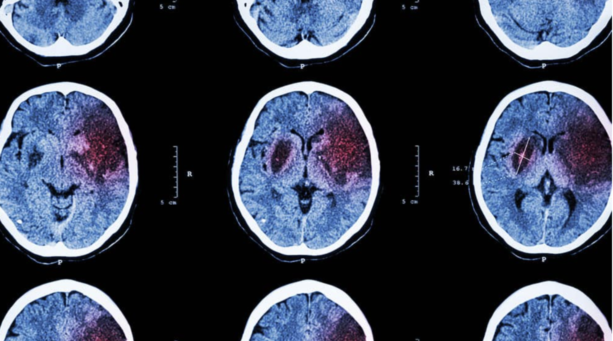 isquemia cerebral a avc