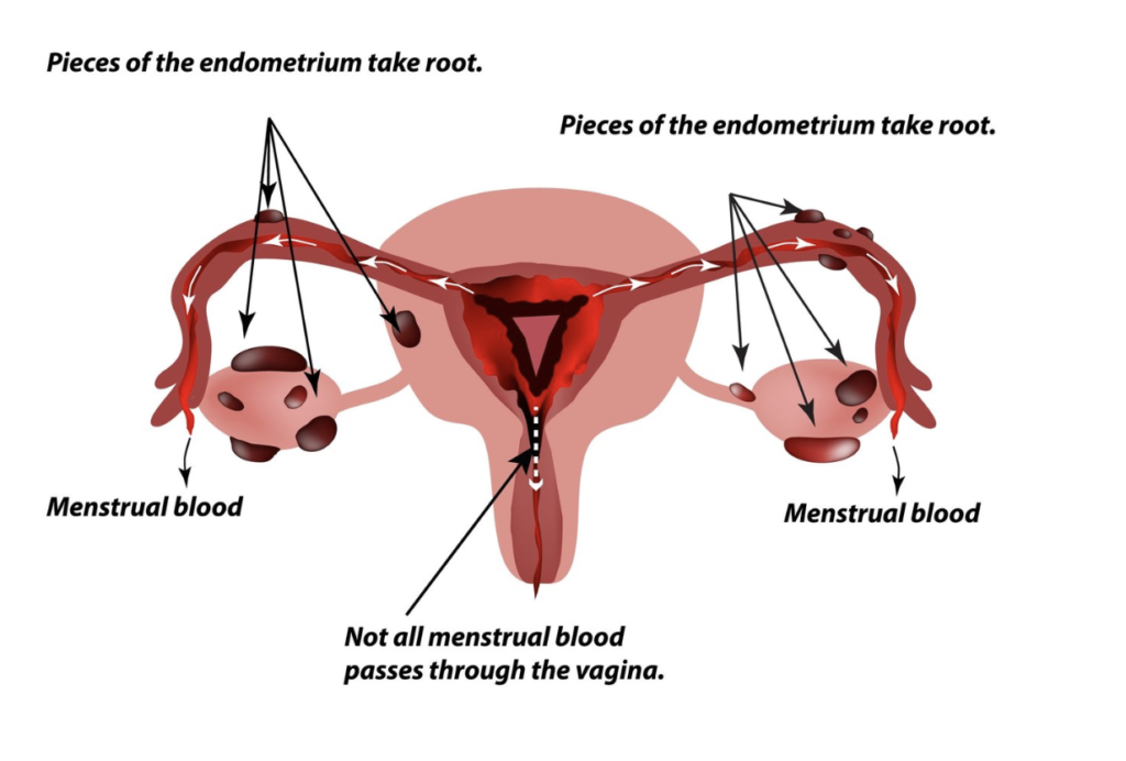 endometriose